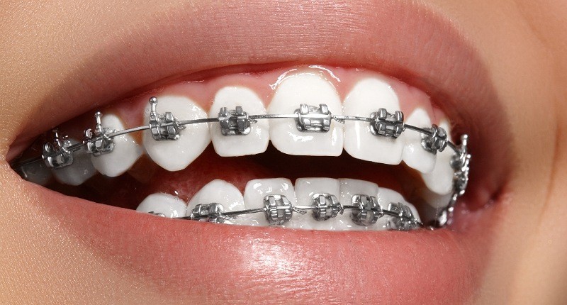 Pentingnya Perawatan Scaling untuk Kesehatan Gigi dan Mulut