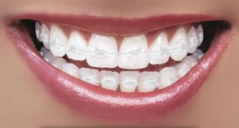 Mengenal Perawatan Orthodontik Behel Sapphire, Transparan dan Estetik