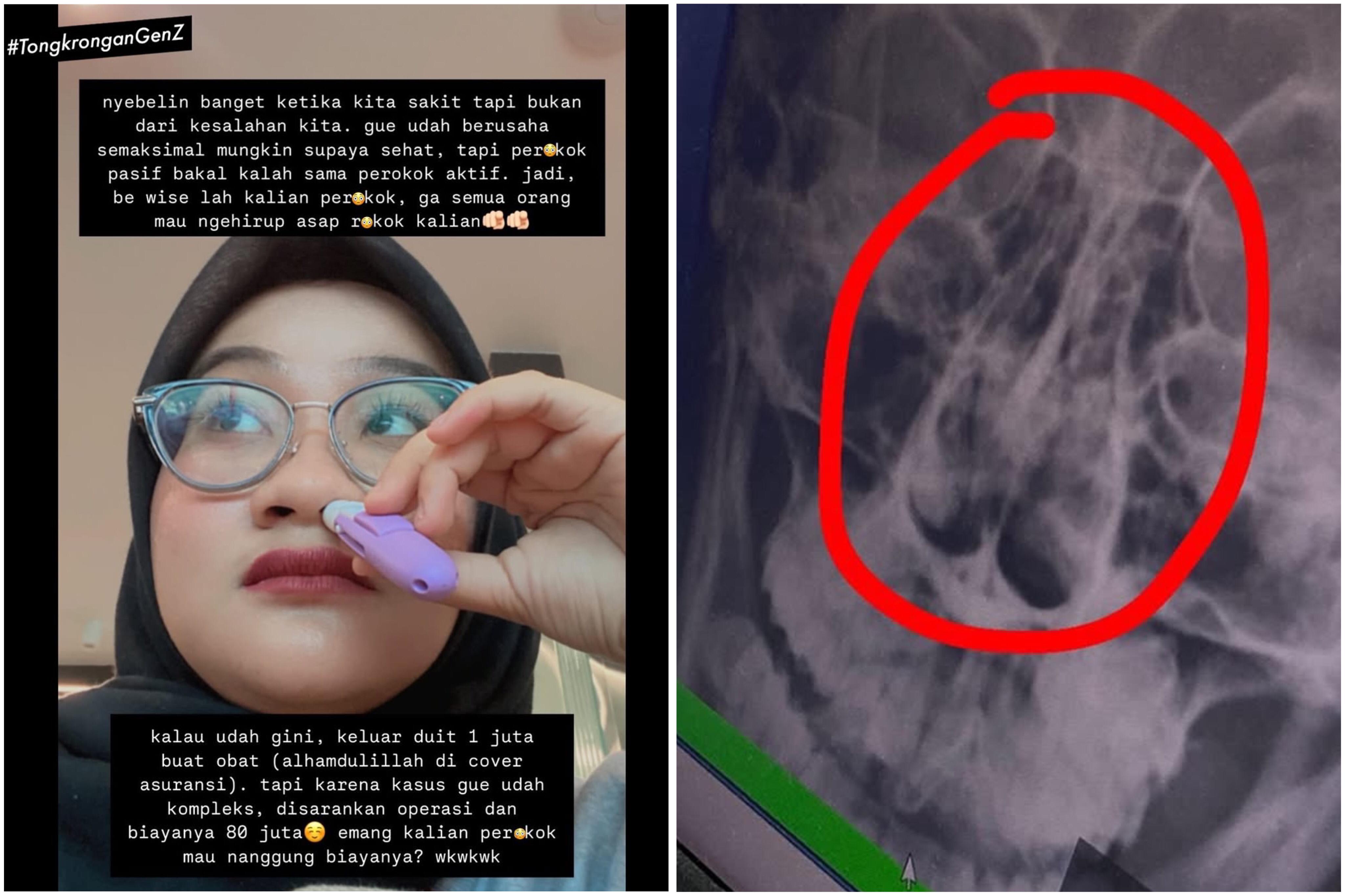 Heboh Gara-Gara Asap Rokok Perempuan Muda Alami Hipertrofi Konka, Disarankan Operasi Biaya Rp80 Juta!