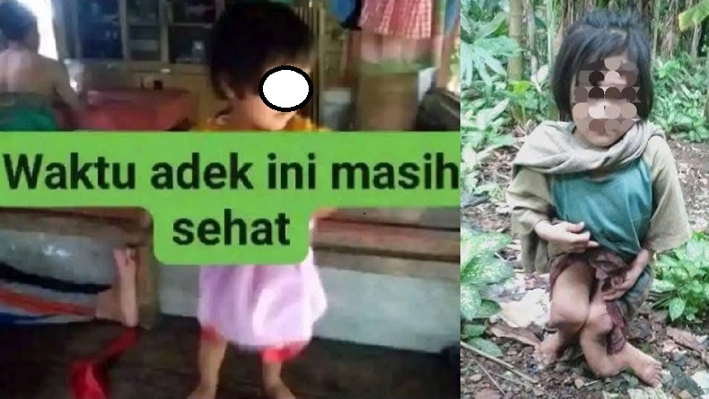 Bantahan Tetangga soal Klaim Dinkes Sumut Kaki Patah Bocah di Nias Selatan Bawaan Lahir