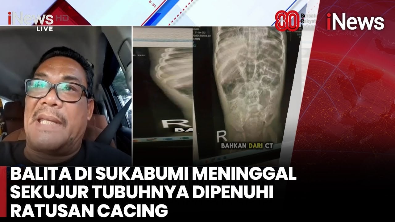 Hidung Keluar Cacing Hidup, Balita Sukabumi Meninggal Setelah 8 Hari Dirawat