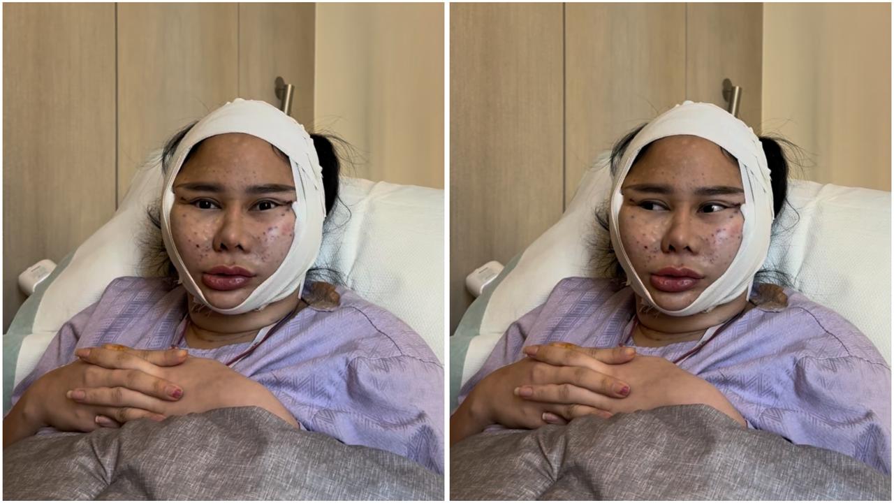 Muka Denise Chariesta Mendadak Bengkak dan Sulit Bicara, Ini Faktanya!