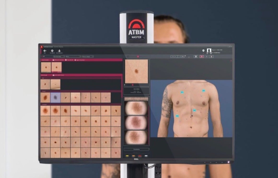 Ancaman Sinar UV, Teknologi AI Bisa Deteksi Dini Kanker Kulit