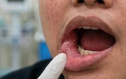 Kasus Campak Turun 93 Persen, Kemenkes Pastikan Pengawasan Tetap Ketat