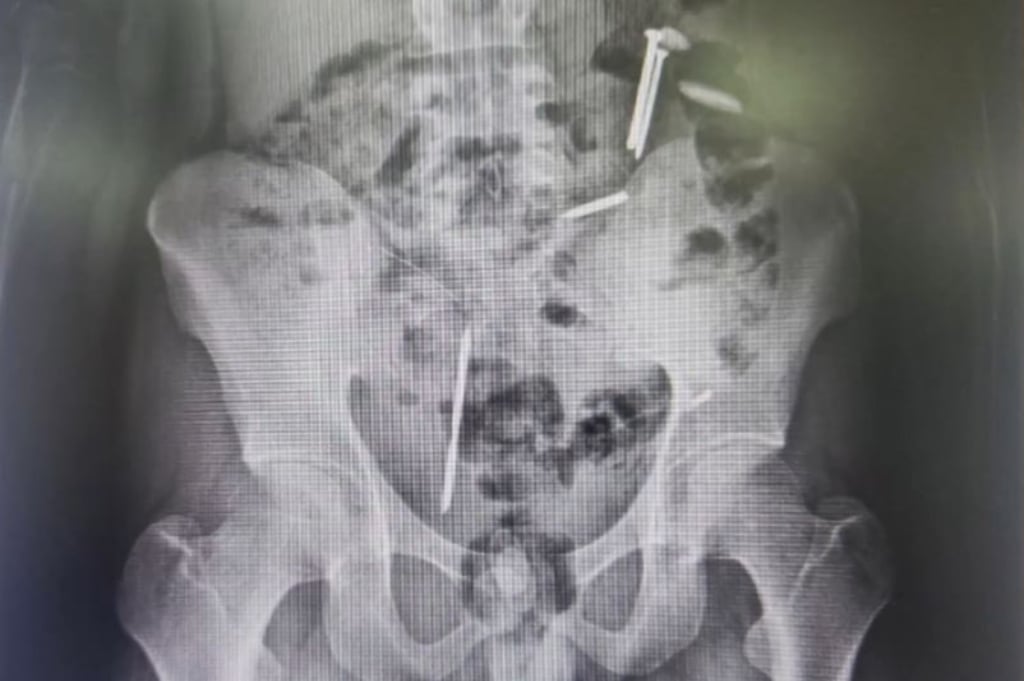 Ngeri! Paku hingga Koin Ditemukan dalam Tubuh Remaja asal Jember, kok Bisa?