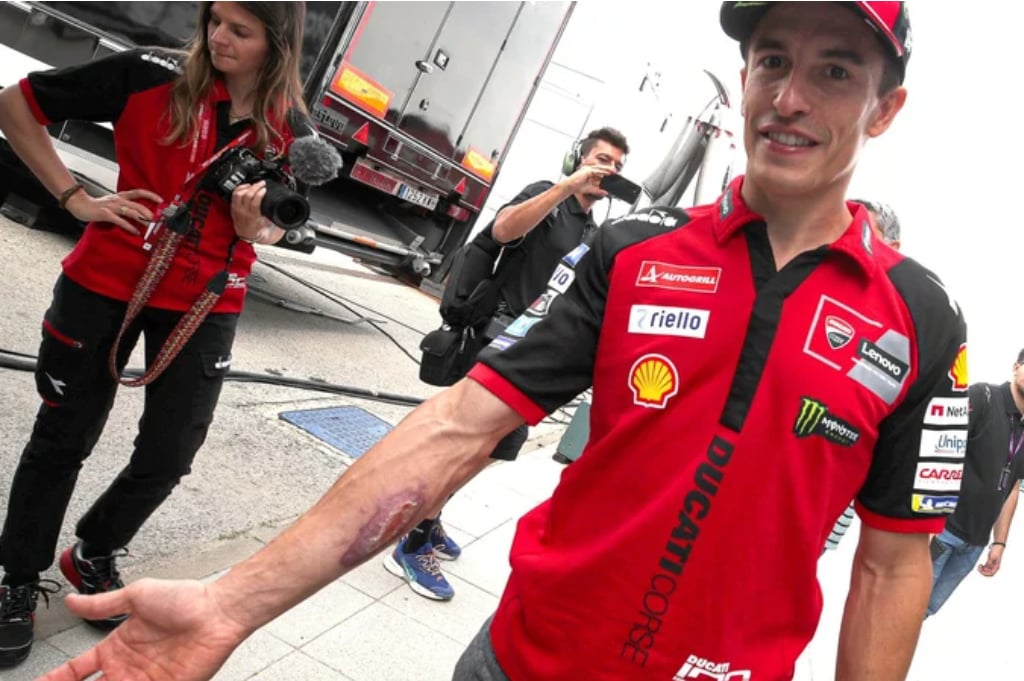 Luka Parah Marc Marquez Terungkap Jelang MotoGP Spanyol, Tetap Ngotot Balapan