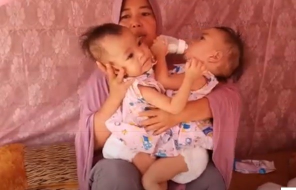 12 Bayi Kembar Siam2 Bayi kembar siam Inaya dan Anaya asal Lombok Timur tak kunjung dioperasi akibat wabah corona. (Foto: iNews/Ramli Nurawang)