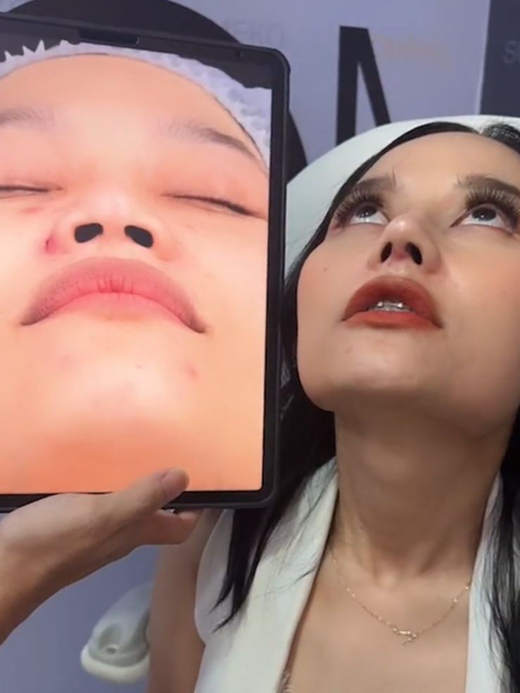 Perubahan hidung Riyuka Bunga