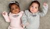 Bayi Kembar di Inggris Ini Lahir dengan Warna Kulit Berbeda