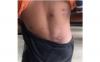Warga Kumai Kobar Diserang Penyakit Gatal hingga Bernanah, Diduga Scabies
