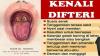 Difteri Ancam Kesehatan Masyarakat, Dinkes KBB Waspada dan Lakukan Deteksi Dini