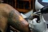 Hapus Tato Gratis dengan Laser - Bagian 4