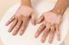 Apa Itu Vitiligo? Penyakit Kulit yang Ramai di Medsos