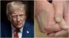 Tangan Donald Trump Bengkak dan Membiru, Kenali Gejala Awalnya