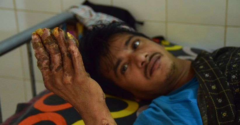 Meski Dioperasi 24 Kali, Penyakit 'Manusia Pohon' di Bangladesh Kambuh
