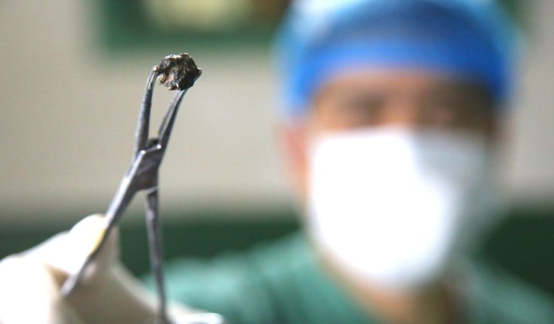 Ada Peluru Bersarang di Kaki Perempuan Ini Selama 72 Tahun