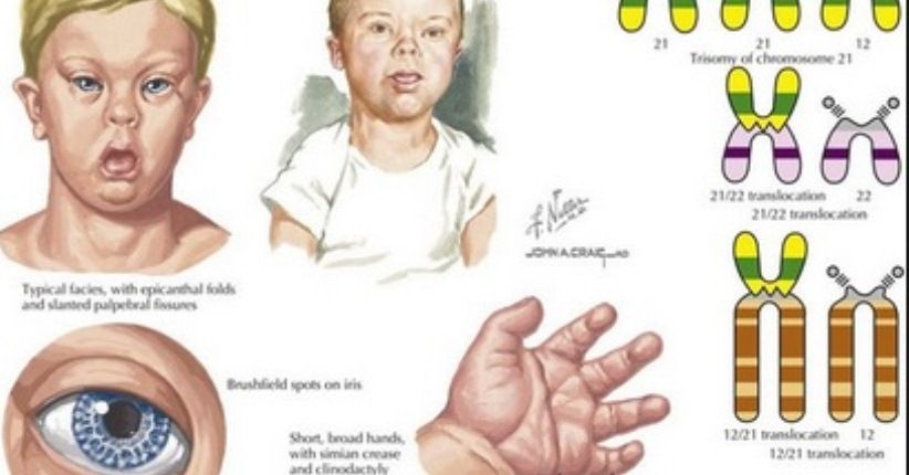 Mengenal Down Syndrome di Hari Down Syndrome Sedunia 2018