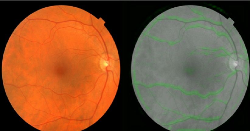 Algoritma AI Google Bisa Baca Penyakit Jantung lewat Mata