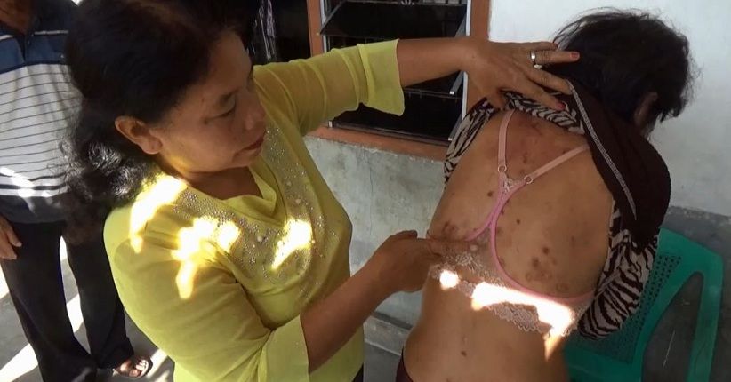 PRT Luka di Sekujur Tubuh akibat Disiksa Majikan di Pematangsiantar