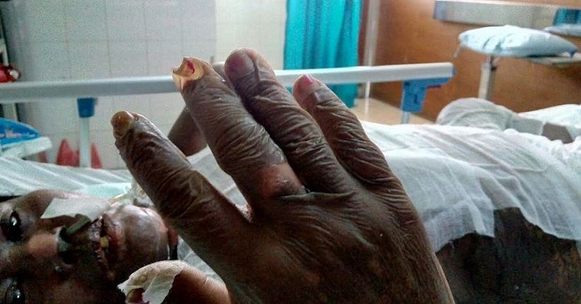 Diduga Jadi Korban Malapraktik, Kulit Pasien RSUP Adam Malik Melepuh