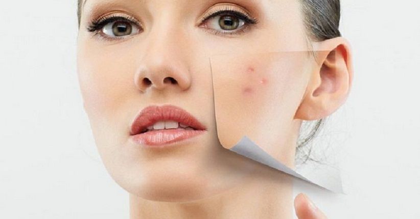 Obat Rumahan Ampuh Atasi Jerawat