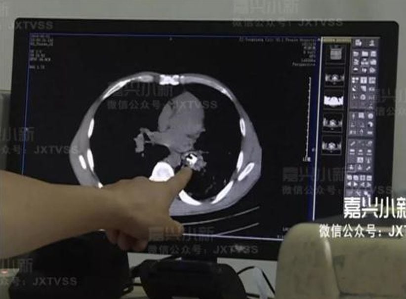 Edan, Rumah Lampu Bersarang di Paru-Paru Pria Ini Selama 30 Tahun