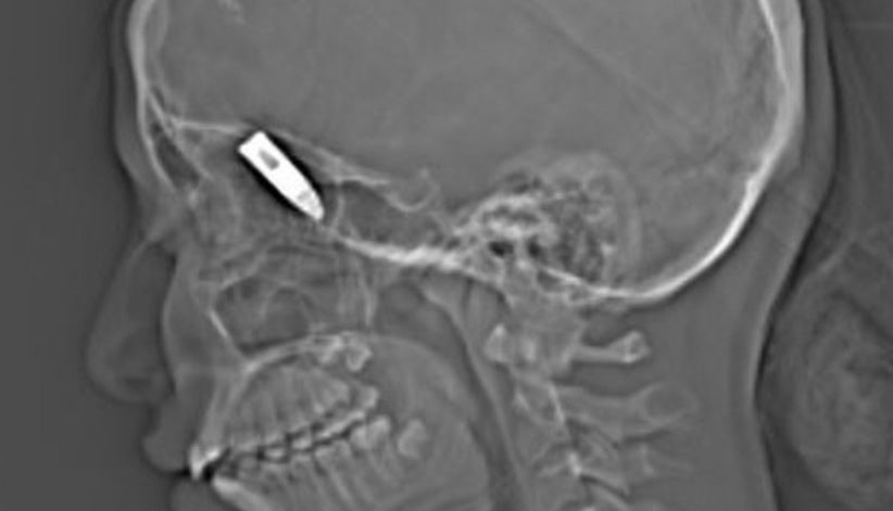 Ajaib, Anak Perempuan Ini Selamat meski Kepalanya Diterjang Peluru