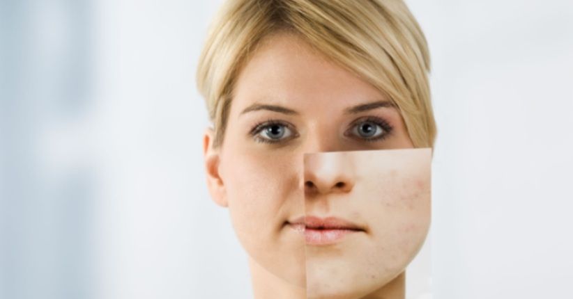 Ladies Wajib Tahu, 4 Cara Ampuh Hilangkan Bekas Jerawat