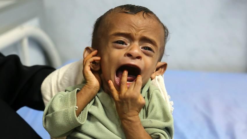 Kelaparan Ancam 5 Juta Anak Yaman, 36.000 Bakal Meninggal Sebelum 2019