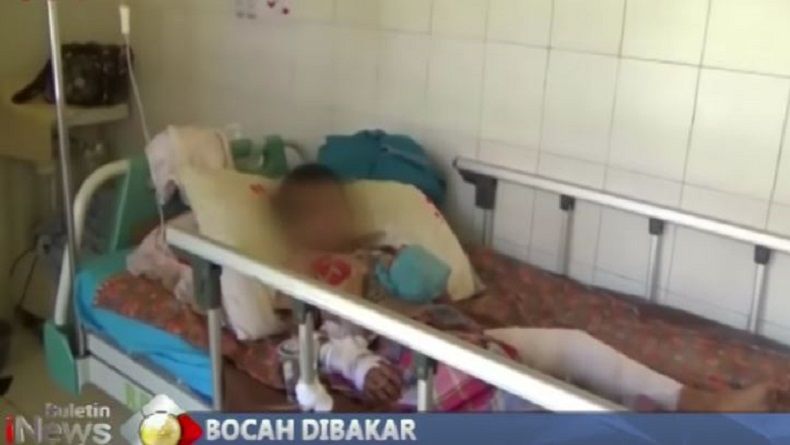 Bocah 8 Tahun di Tanjungbalai Dibakar Teman dan Disuruh Minum Air Seni