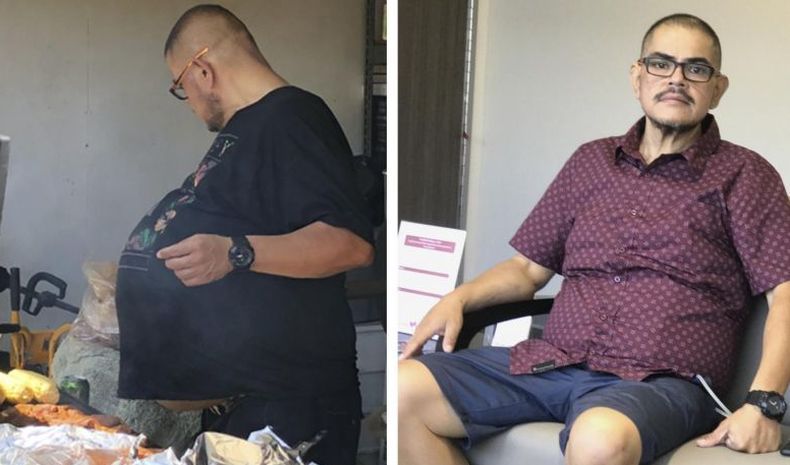 Pria Ini Mengira Perutnya Kegemukan, Ternyata Ada Tumor 35 kg