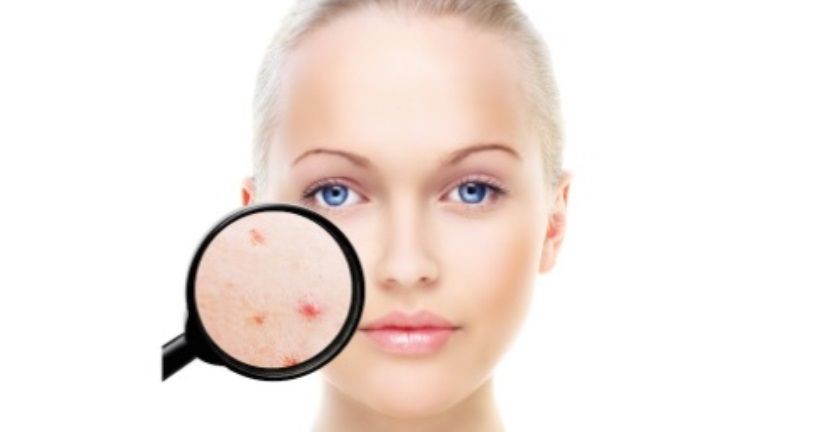 Muncul Setiap Bulan, Begini Cara Mengatasi Jerawat Hormonal