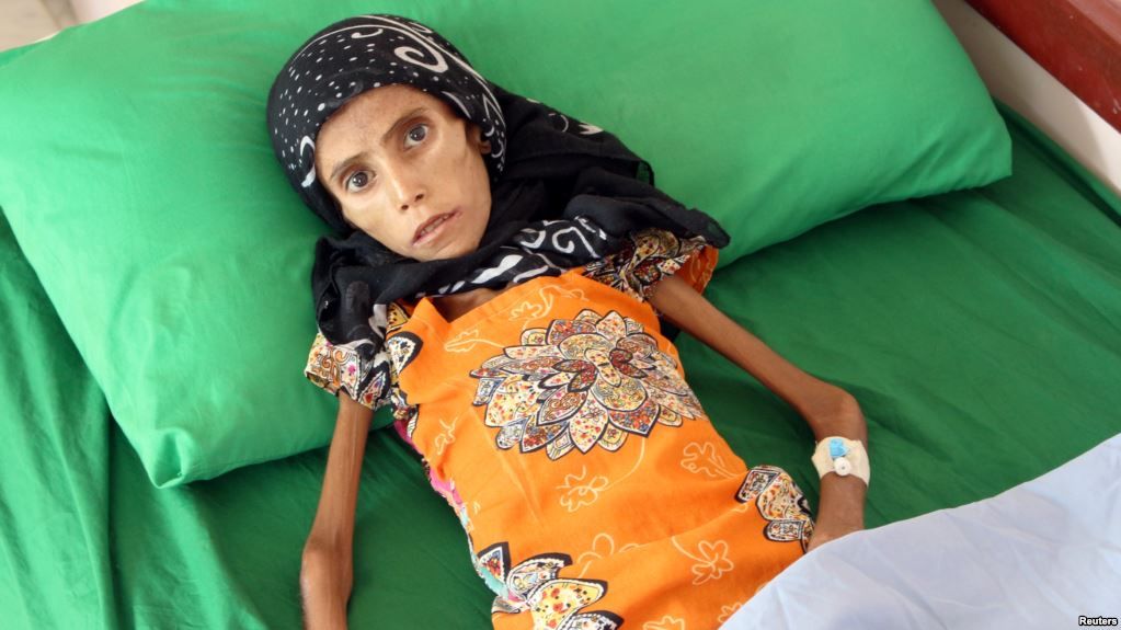 Kisah Fatima: Gadis Malnutrisi Korban Perang Yaman yang Hidup di Pohon