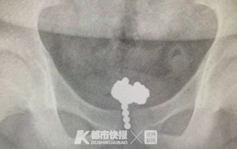 Lagi, Bocah Dioperasi karena Masukkan 70 Bola Magnet ke Alat Kelamin