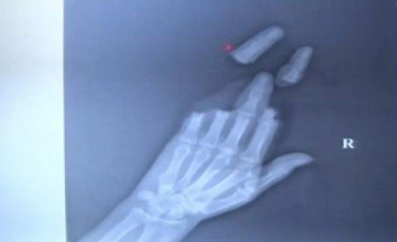 3 Jari Pria Ini Terpotong Benang saat Main Layang-Layang