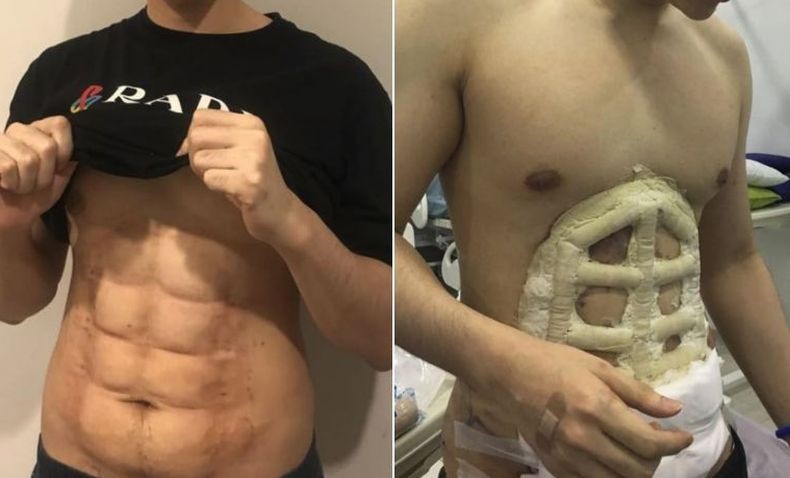 RS di Thailand Ini Bisa Sulap Pria Gemuk Jadi Six Pack dalam Sekejap