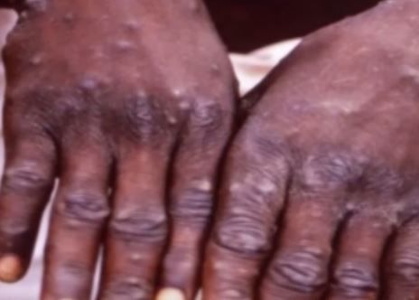 Dinkes DKI Pastikan Belum Ada Warga Terjangkit Penyakit Cacar Monyet