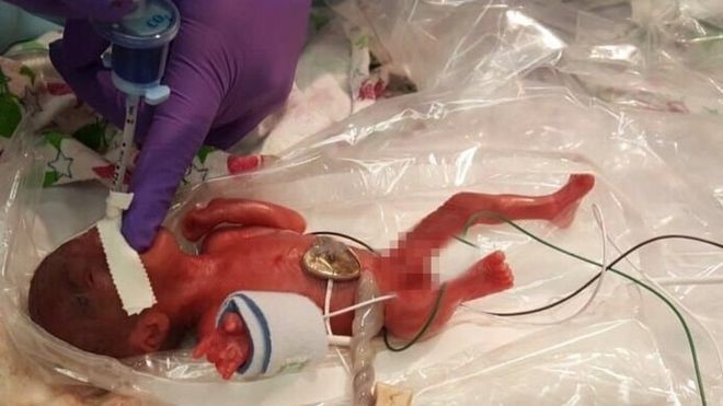 Lahir Seberat 245 Gram, Bayi Prematur Termungil di Dunia Berhasil Bertahan Hidup