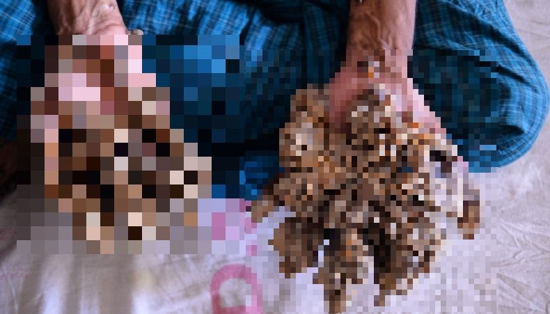 Kesakitan, Manusia Pohon Asal Bangladesh Minta Tangannya Diamputasi