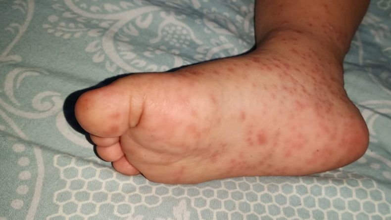 Warga Medan Geger dengan Wabah Virus Flu Singapura