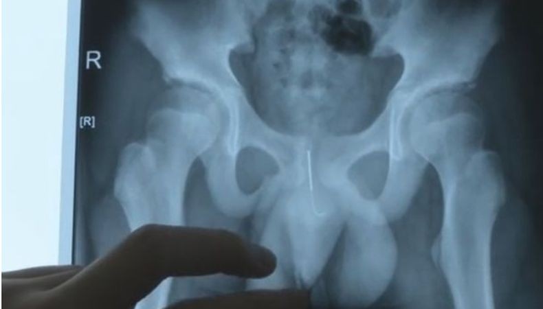 Remaja Ini Masukkan Jarum ke Alat Kelamin agar Tak Tertidur saat Kerjakan PR