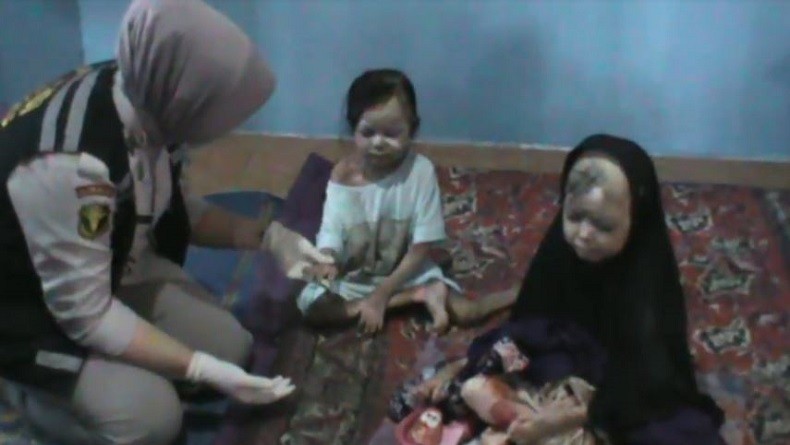 2 Bocah Kakak Adik di OKU Sumsel Menderita Penyakit Aneh