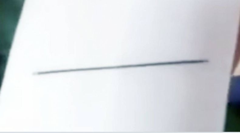 Ngeri, Nenek Ini Hidup dengan Jarum Tertancap di Otak selama 80 Tahun