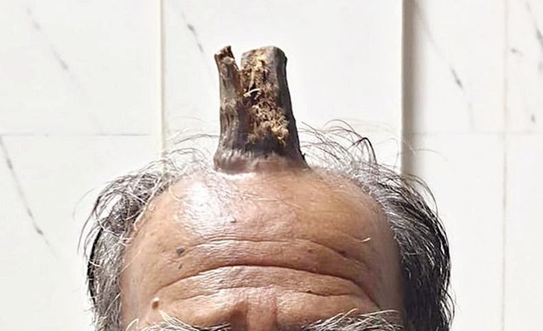 Aneh, di Kepala Pria India Ini Tumbuh Tanduk 10 Cm