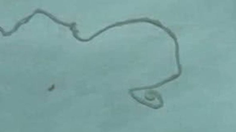 Cacing Pita Bersarang Selama 15 Tahun di Kepala Pria Ini, Gerogoti Otak