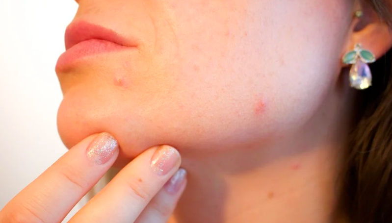 Waspada, Stres Berlebihan di Masa Pandemi Corona Bisa Timbulkan Gatal dan Jerawat