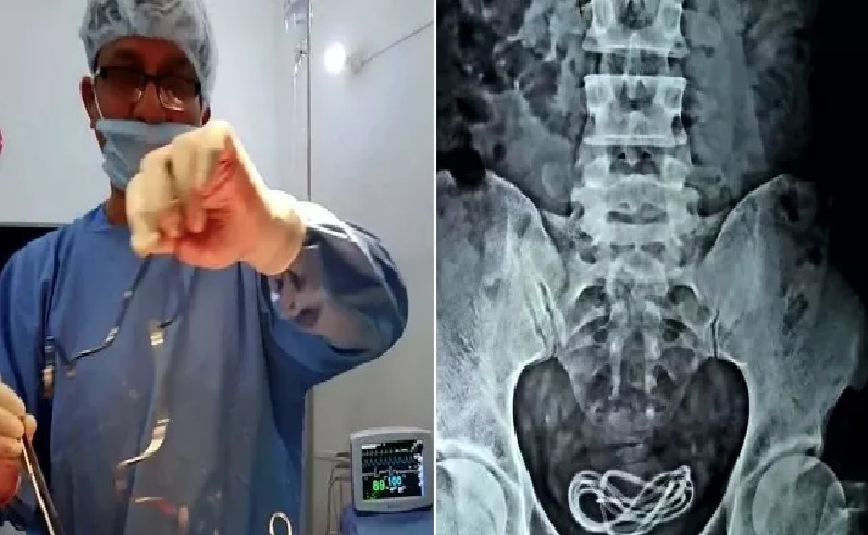 Pria di India Masukan Kabel Charger HP lewat Alat Kelamin Demi Kepuasan Seksual