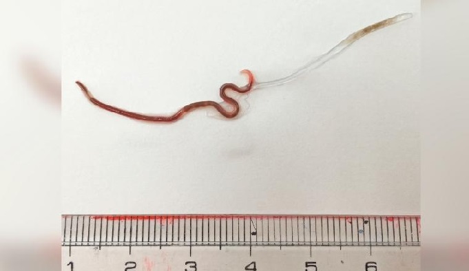 Cacing Parasit Ditemukan Hidup dalam Amandel Perempuan Jepang usai Makan Sushi Mentah