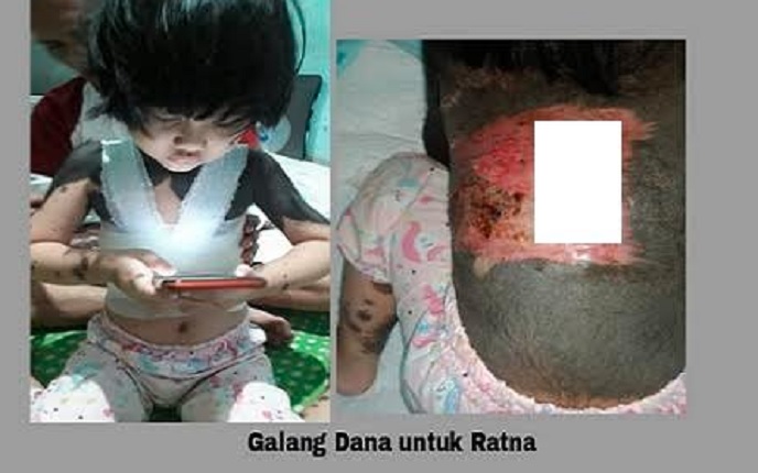 Kisah Haru Ratna Maya Bocah Penderita Kelainan Kulit asal Rembang