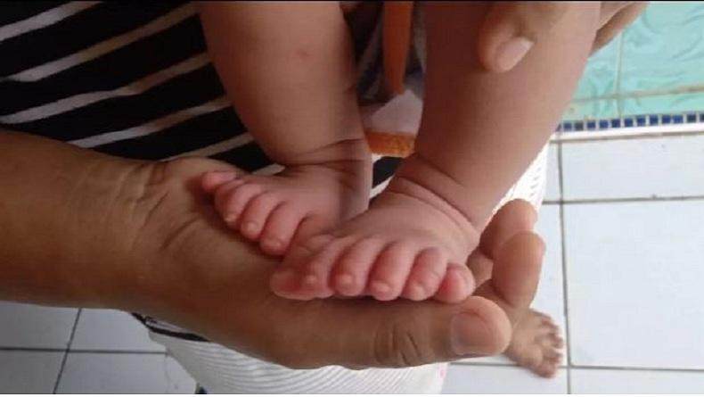Viral Kakak Adik Galuh dan Galih asal Indramayu Punya 12 Jari Tangan dan Kaki
